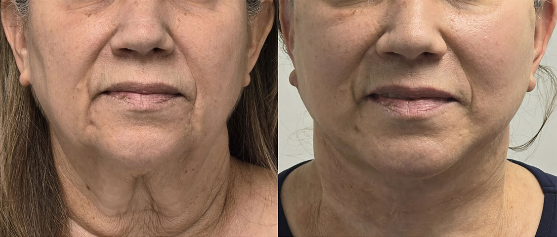 Facelift before and after photo